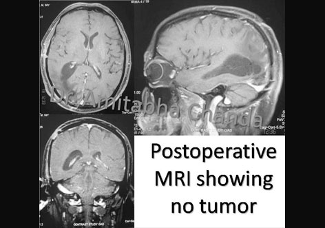 tumors